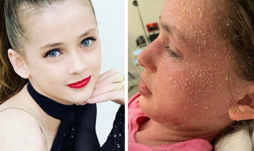 Eczema: Summah Williams, 11, allergic to her personal tears, MooGoo eczema cream